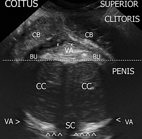 Figure 3. Coronal plane of the coitus: the clitoral complex is pushed up and crushed against the anterior vaginal wall. CB = clitoral body; K = Kobelt plexus; VA = vagina; BU = bulb; CC = corpus cavernous; SC = spongiosum corpus.